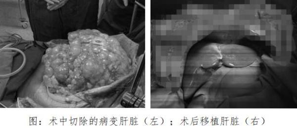 南昌大学二附院移植科成功完成一例巨大多囊肝移植手术